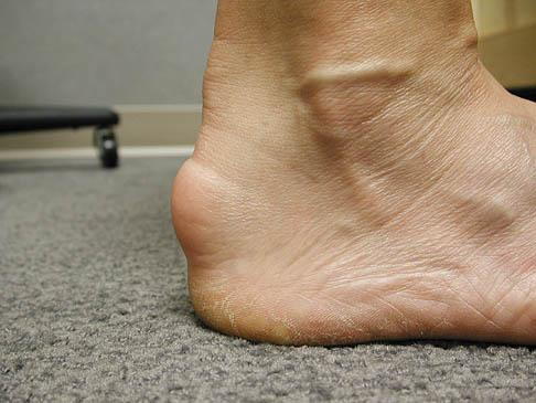 heel lifts achilles tendonitis