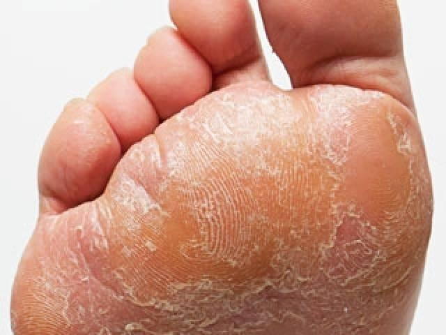 Cracked feet hot sale athletes foot