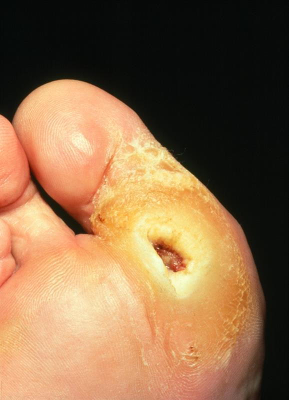 FOOT ULCERS THAT DON'T HEAL COULD MEAN DIABETES STATES PODIATRIST