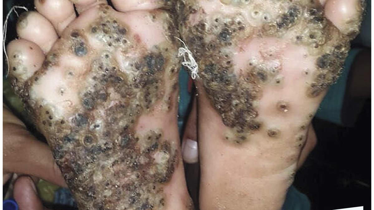 GIRL'S FEET INFESTED WITH PARASITIC SAND FLEAS AFTER RUNNING BAREFOOT  THROUGH PIGSTY