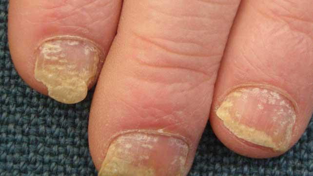 Nail Ridges: Causes and Treatments – Dr. Dana