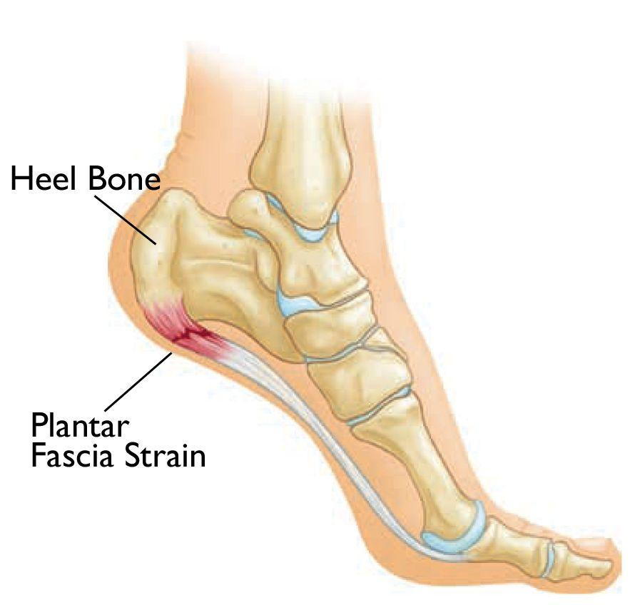 Do Arch Supports Help Ankle Pain? - Foot and Ankle Surgeons of New York