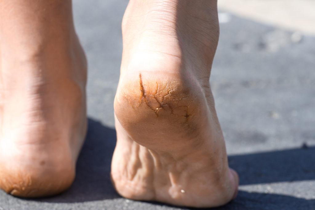 Why do cracked heels hurt?Cracked heels treatment series| The Foot Scraper:  DG Podiatrist - YouTube