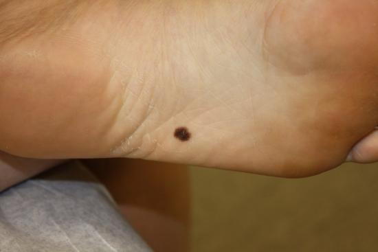 Brown Spots On My Foot Sole