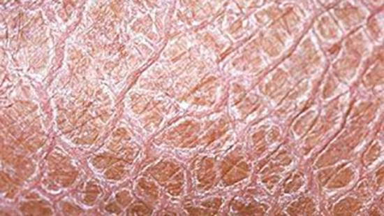 Rare Skin Condition Or Extremely Dry Skin 