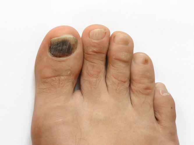 RUNNER'S TOE AND HOW TO TREAT IT