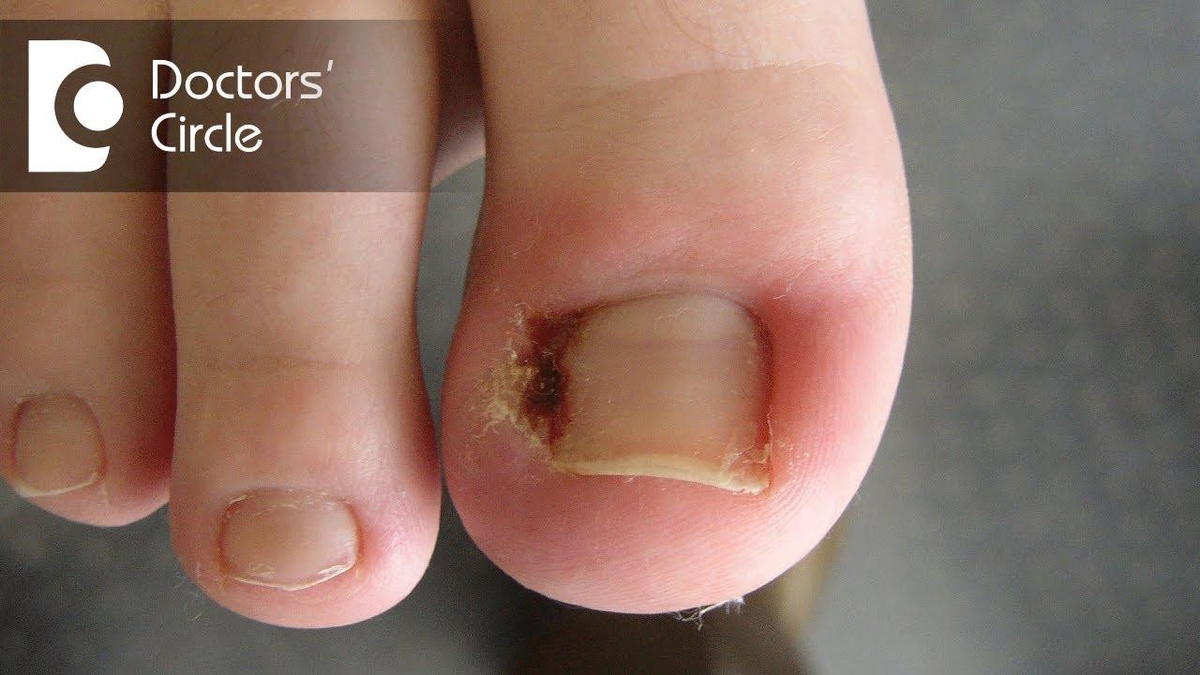 TOE NAIL INFECTIONS CAN SPREAD IF NOT TREATED