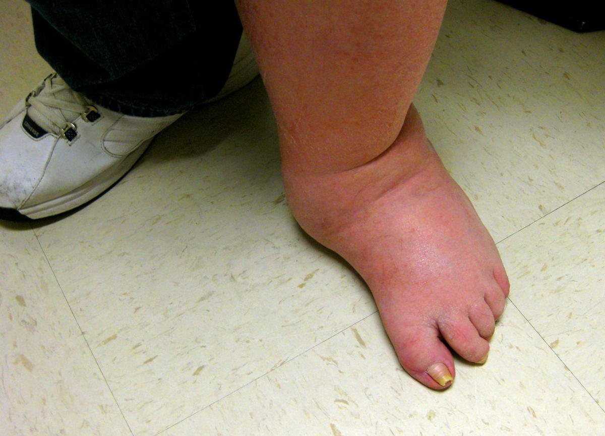 TWO THIRDS OF CLINICIANS LACK KNOWLEDGE OF CHARCOT FOOT