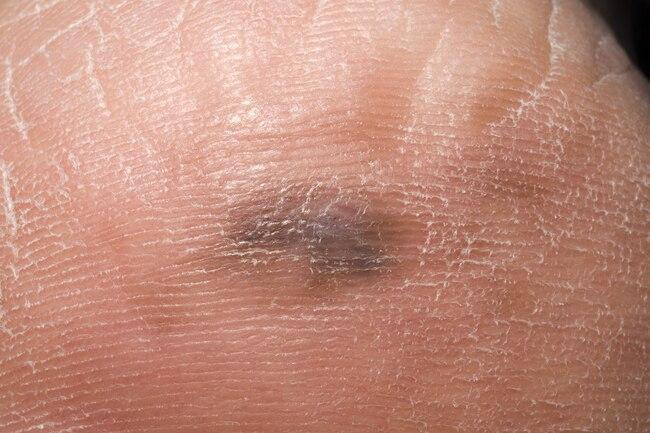 Skin Cancers Of The Feet Are Often Painless