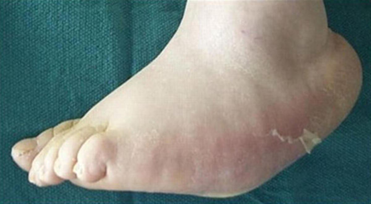 TWO THIRDS OF CLINICIANS LACK KNOWLEDGE OF CHARCOT FOOT