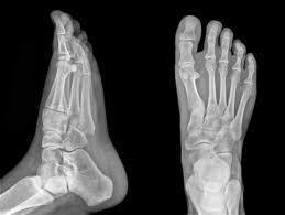 big toe stress fracture
