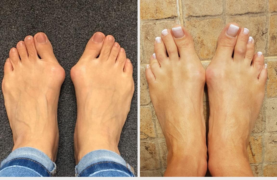 Non-painful bunions don't need surgery.