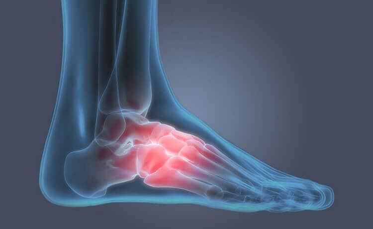 PODIATRIST DISCUSSES CAUSES OF ARCH PAIN IN RUNNERS