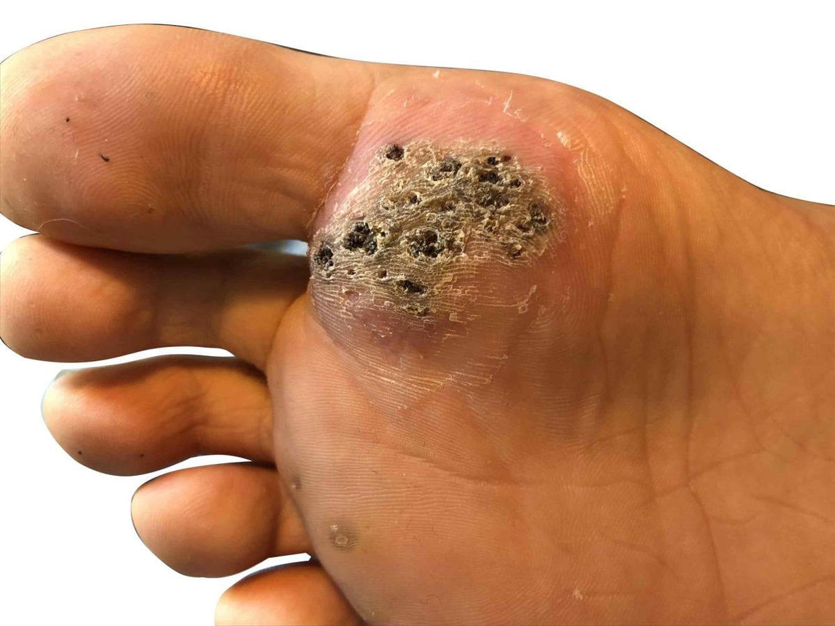 podiatrist-discusses-plantar-warts