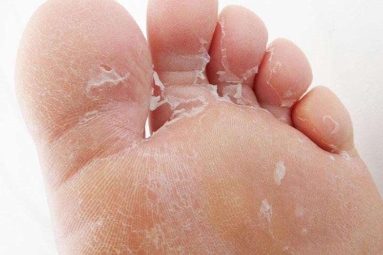 Numbness In Your Toes: What Does it Mean? - Beauchamp Foot Care