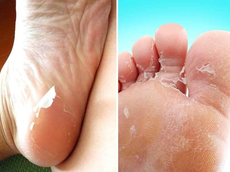Age without aging cracked heels | The Foot Stop