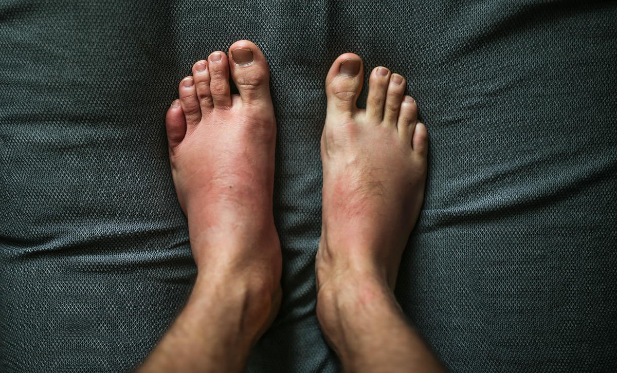 Podiatrist Discusses Effects Of Psoriatic Arthritis On Feet
