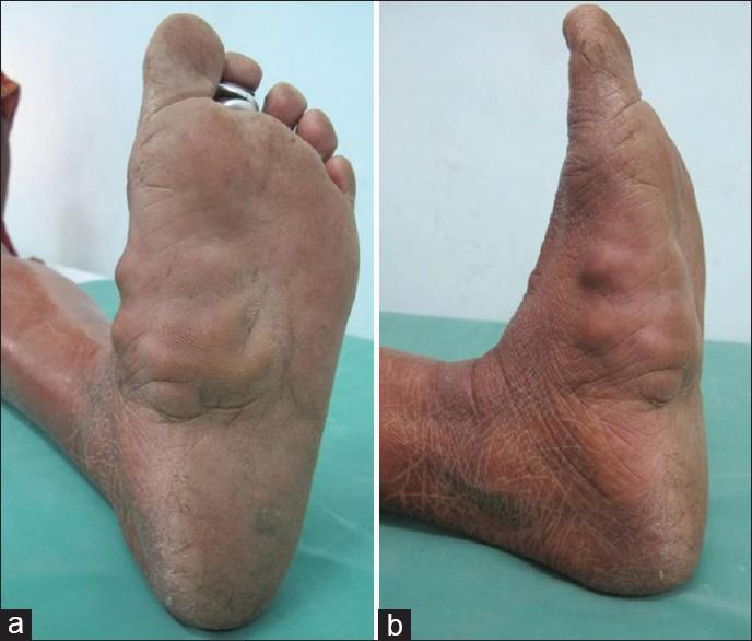 Neurofibroma