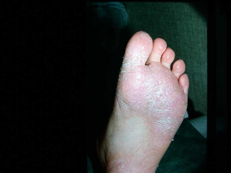 Itching in hands and feet - Causes, and Treatment