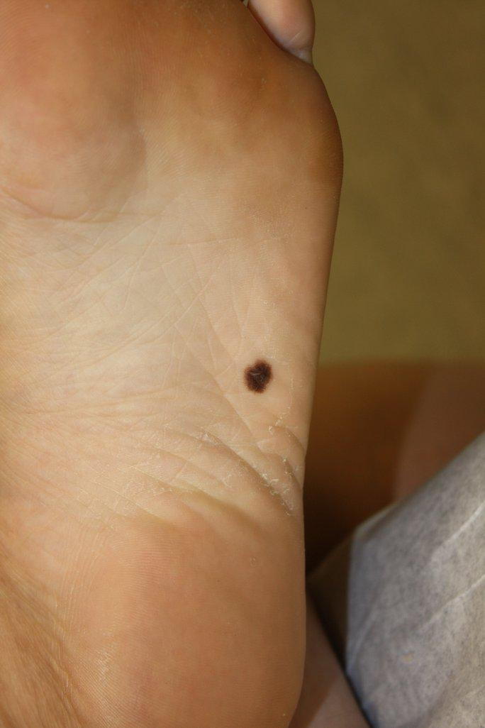 that-dark-spot-on-your-foot-may-be-deadly