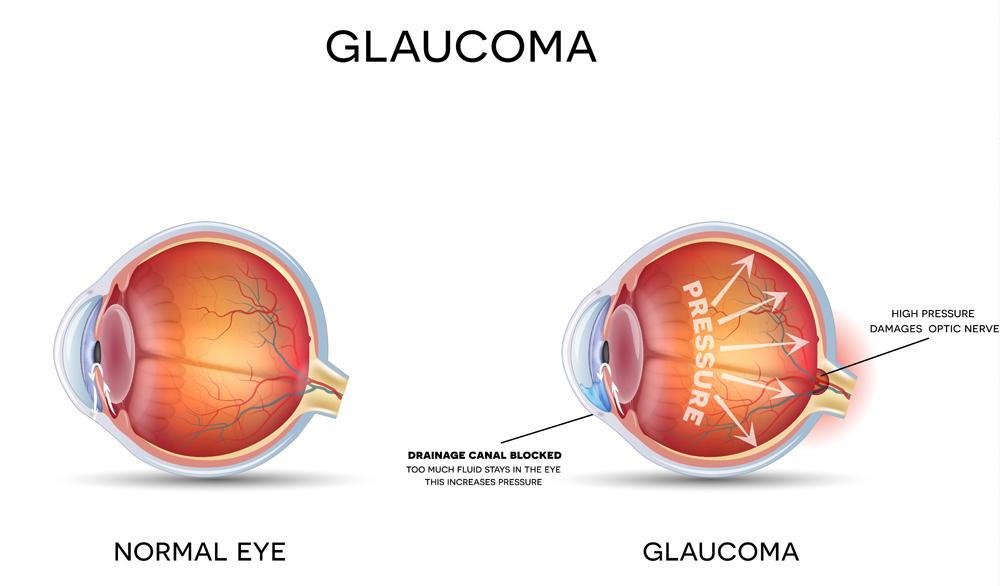 diagram of normal eye vs eye with glaucoma showing pressure build up and nerve damage