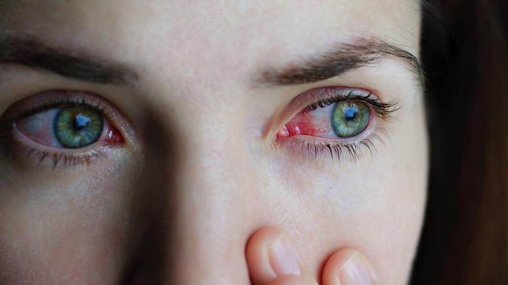 Woman looking out to her left is experiencing redness in her eyes from dry eye symptoms