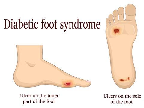 wound healing in diabetic patients