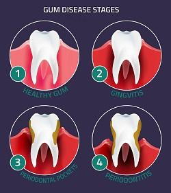 Gum Disease Signs
