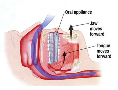 How an oral appliance can help with sleep apnea