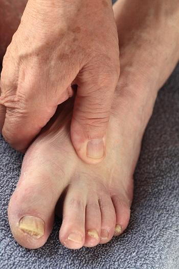 diabetic foot infection