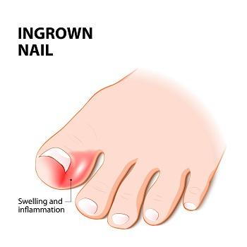 Ingrown Toenails  Ingrown Nail  Painful Nail  Nail