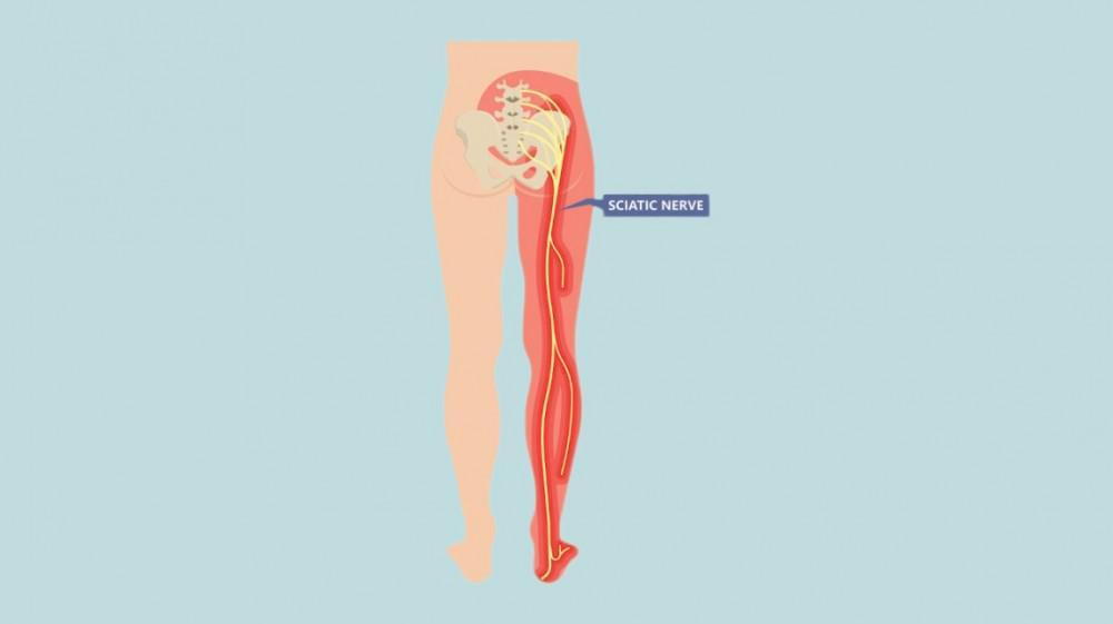 sciatica-symptoms-and-treatment