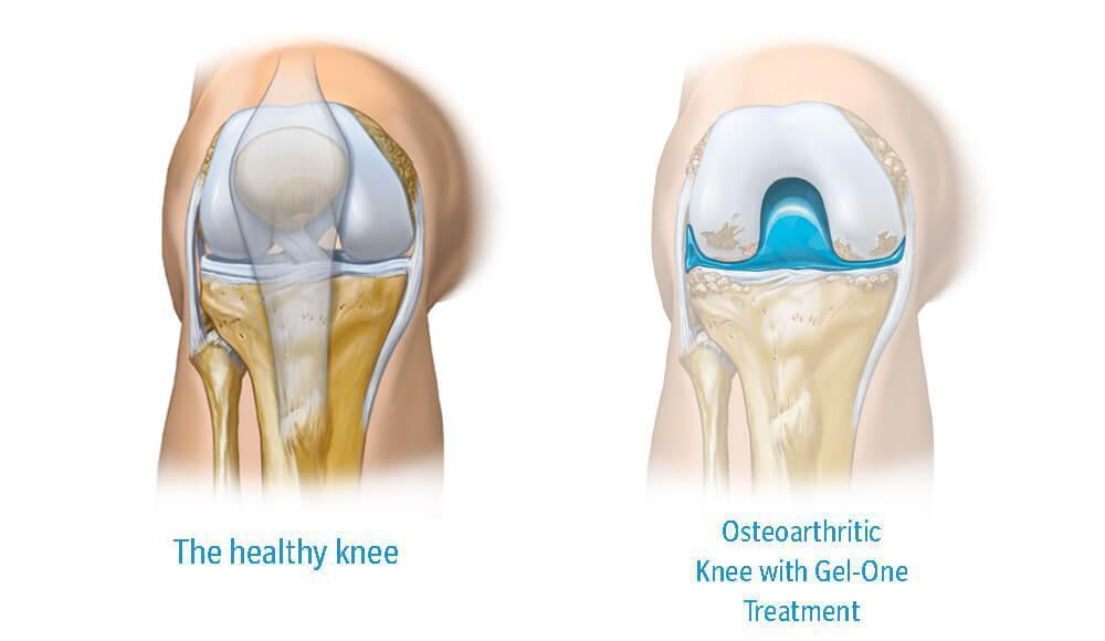 knee-gel-injections