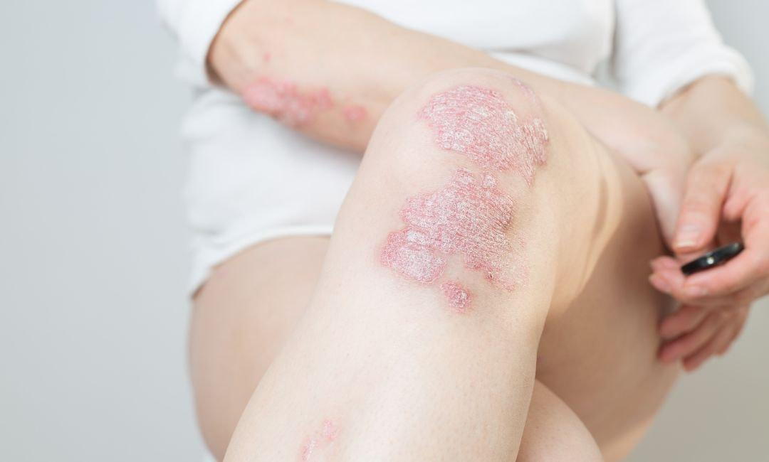 immune response, autoimmune diseases, psoriasis like skin inflammation