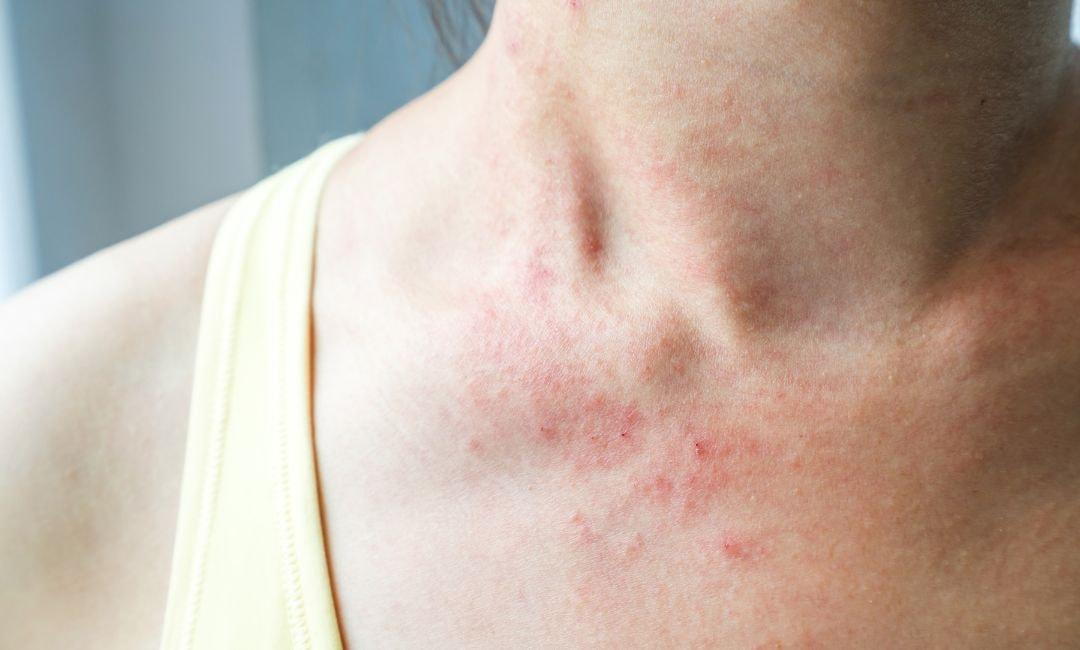 eczema symptoms