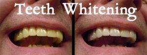 before & after teeth whitening photos of a smile
