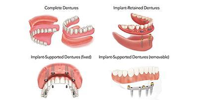 dentures1.png