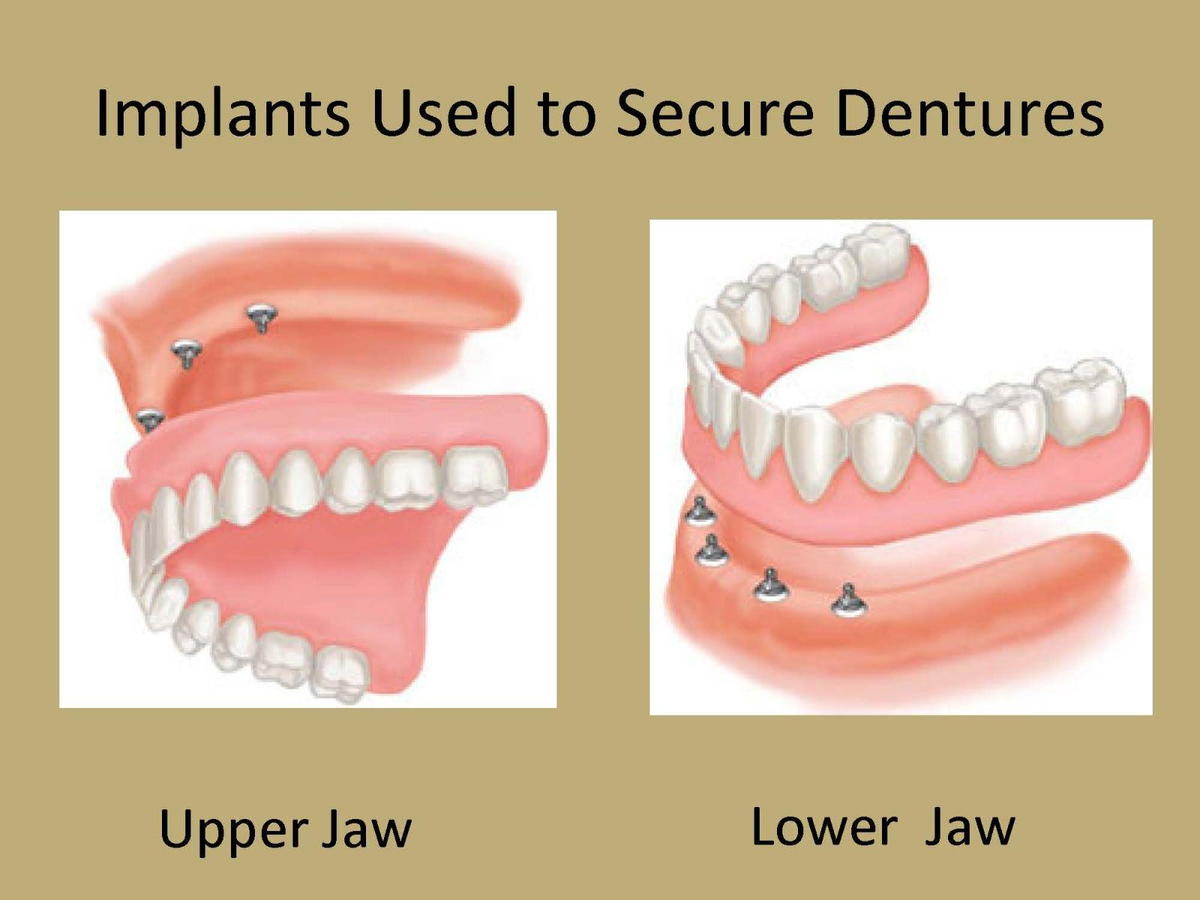 one-day dentures