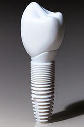 Dental Implants