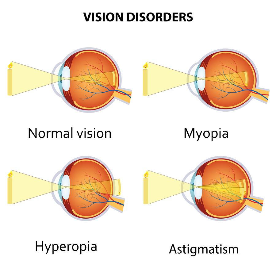 asztigmatikus myopia