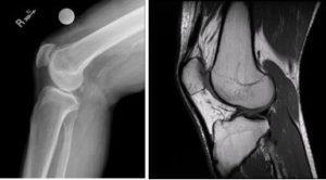 knee xray and knee MRI