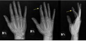 Hand x-ray dislocated finger