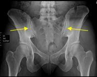 x-ray SI joints