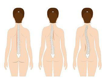 What is Scoliosis of the Spine? How Can It be Treated?