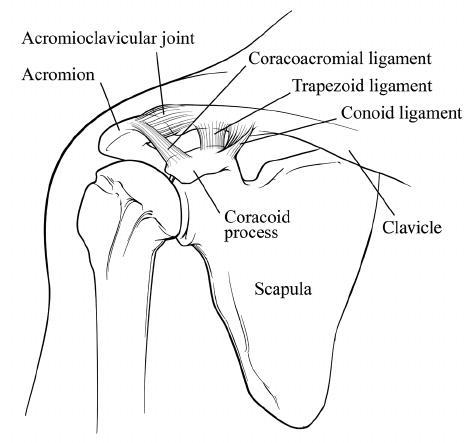 Separated Shoulder, AC Joint Separation