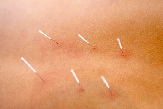 why did i get sore after dry needling