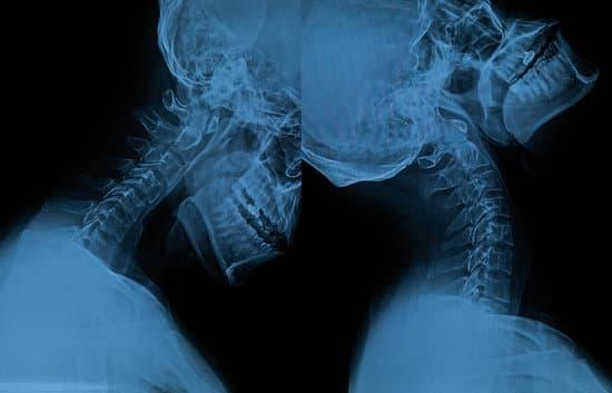 X-ray following motor vehicle accident resulting in whiplash, chiropractic.