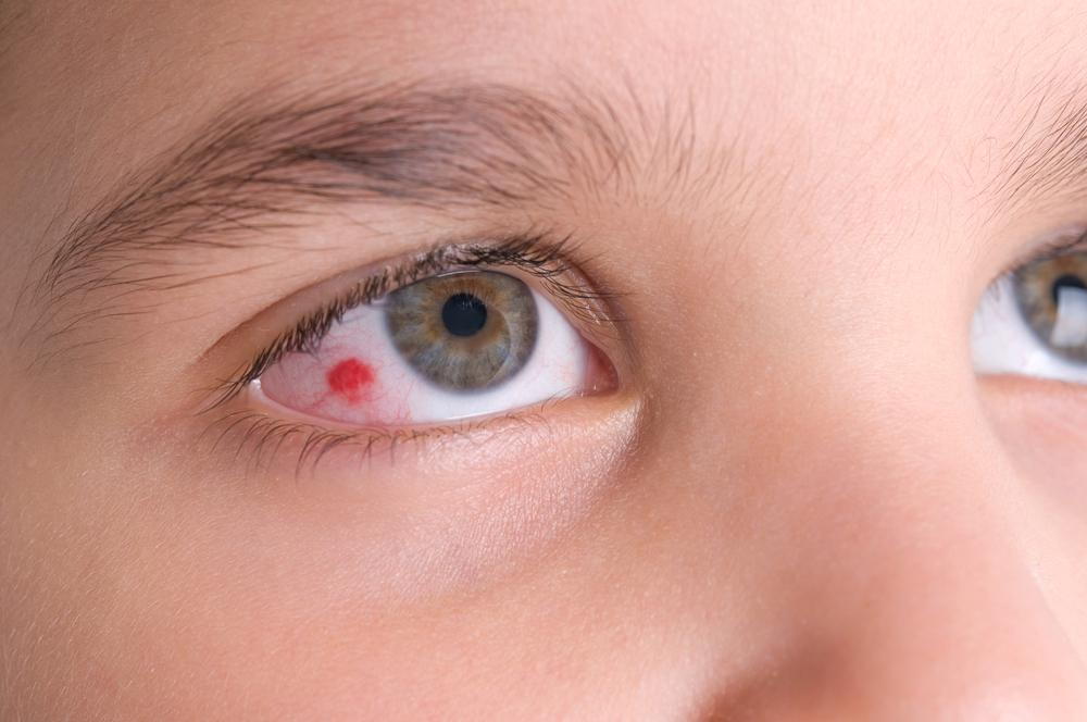 Kid With An Injured Eye