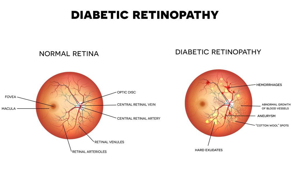 diagram explaining what diabetic retinopathy is