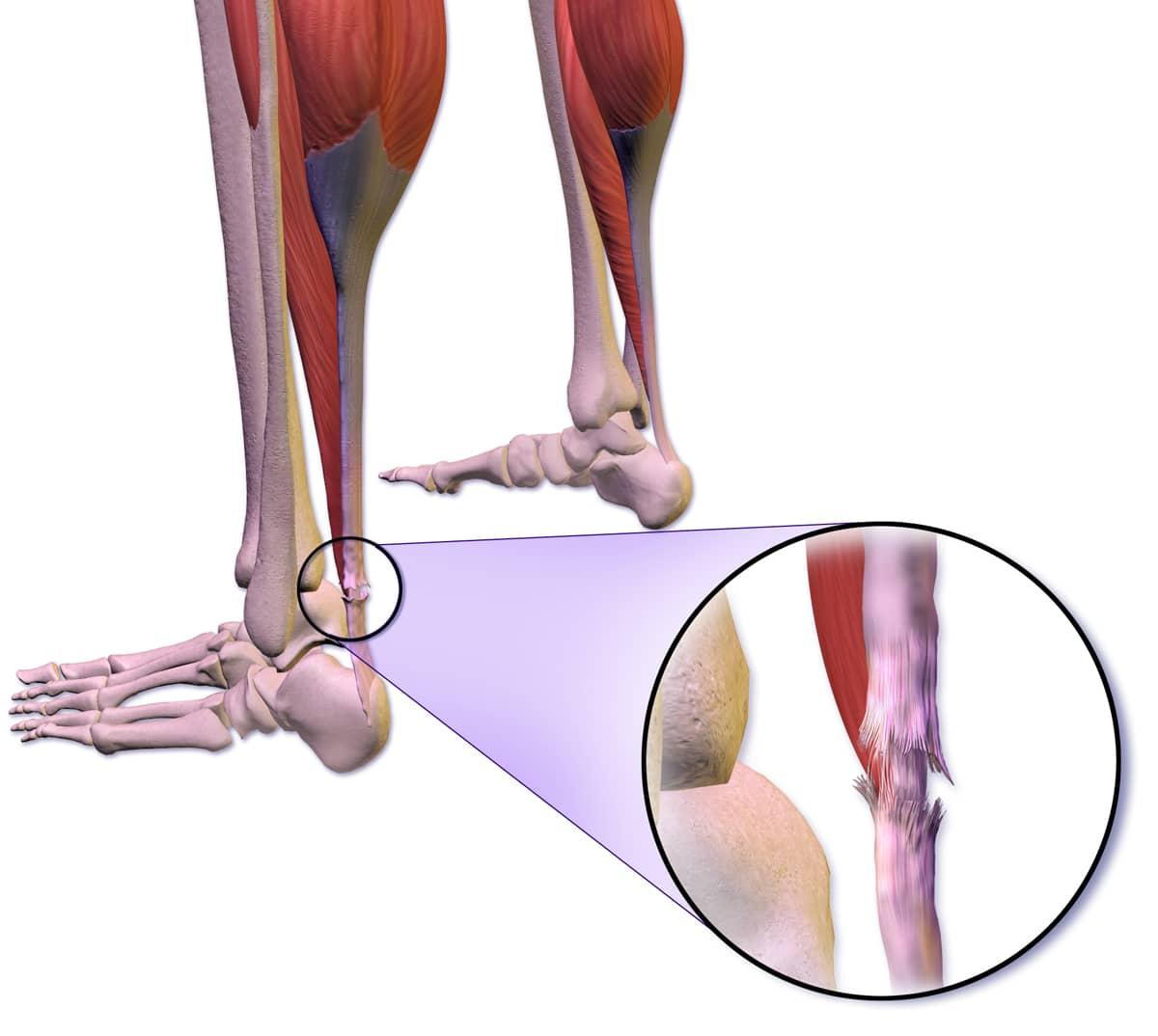 Anatomy of the Achilles Tendon causing pain.